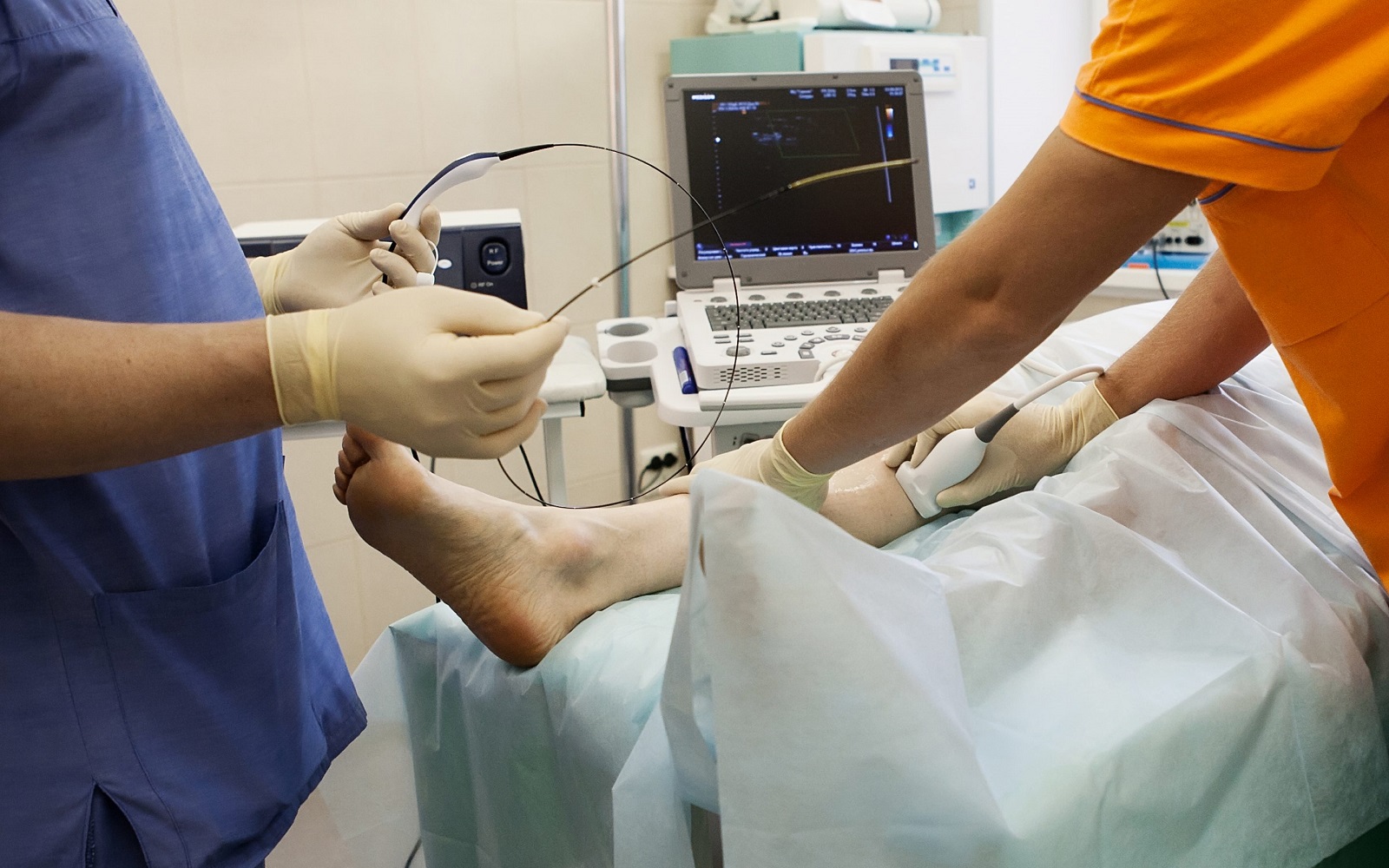 Radiofrequency Ablation RFA 17 FAQs Patients Ask Hamilton Vascular