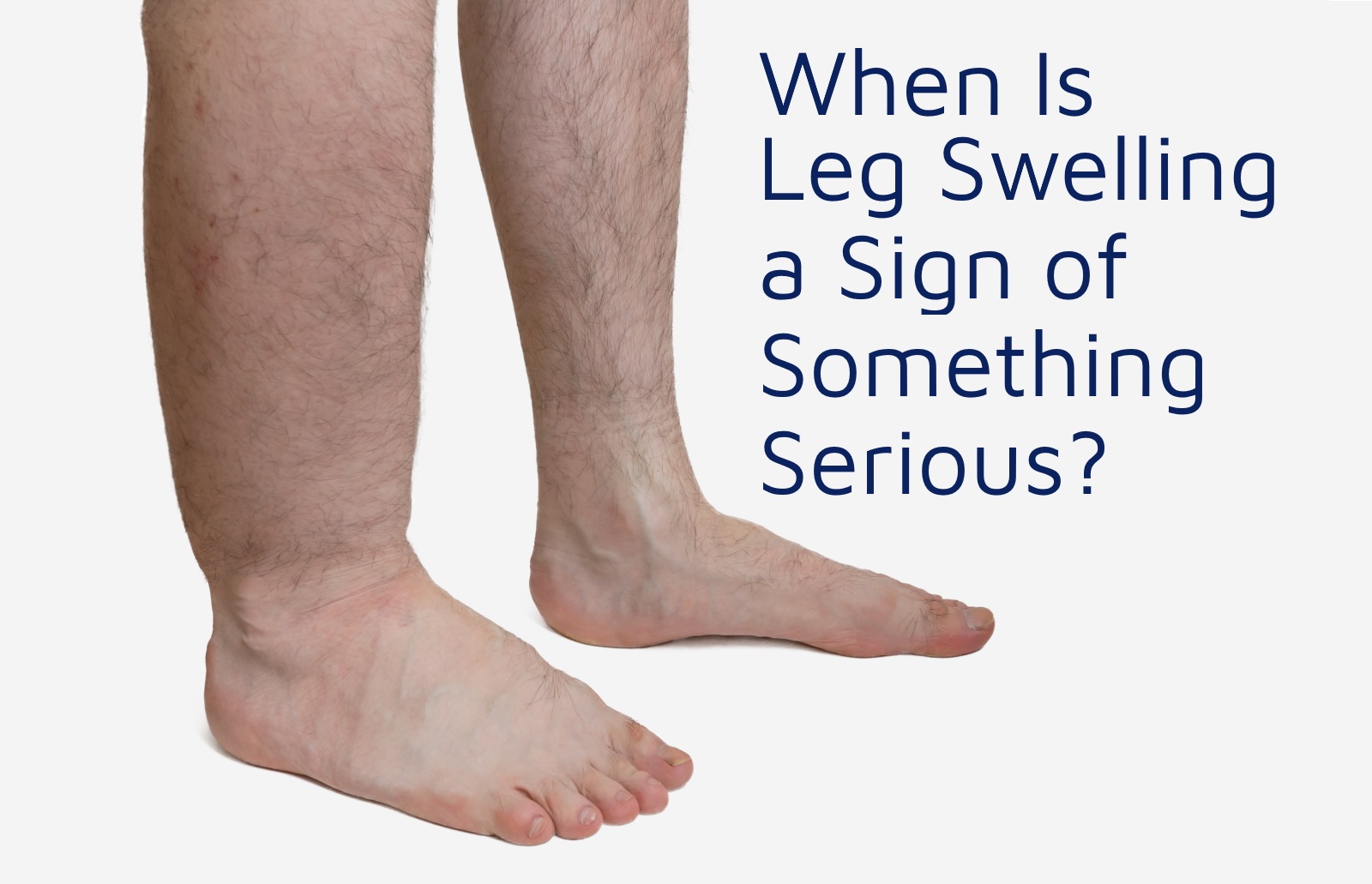 When Is Leg Swelling A Sign Of Something Serious Hamilton Vascular