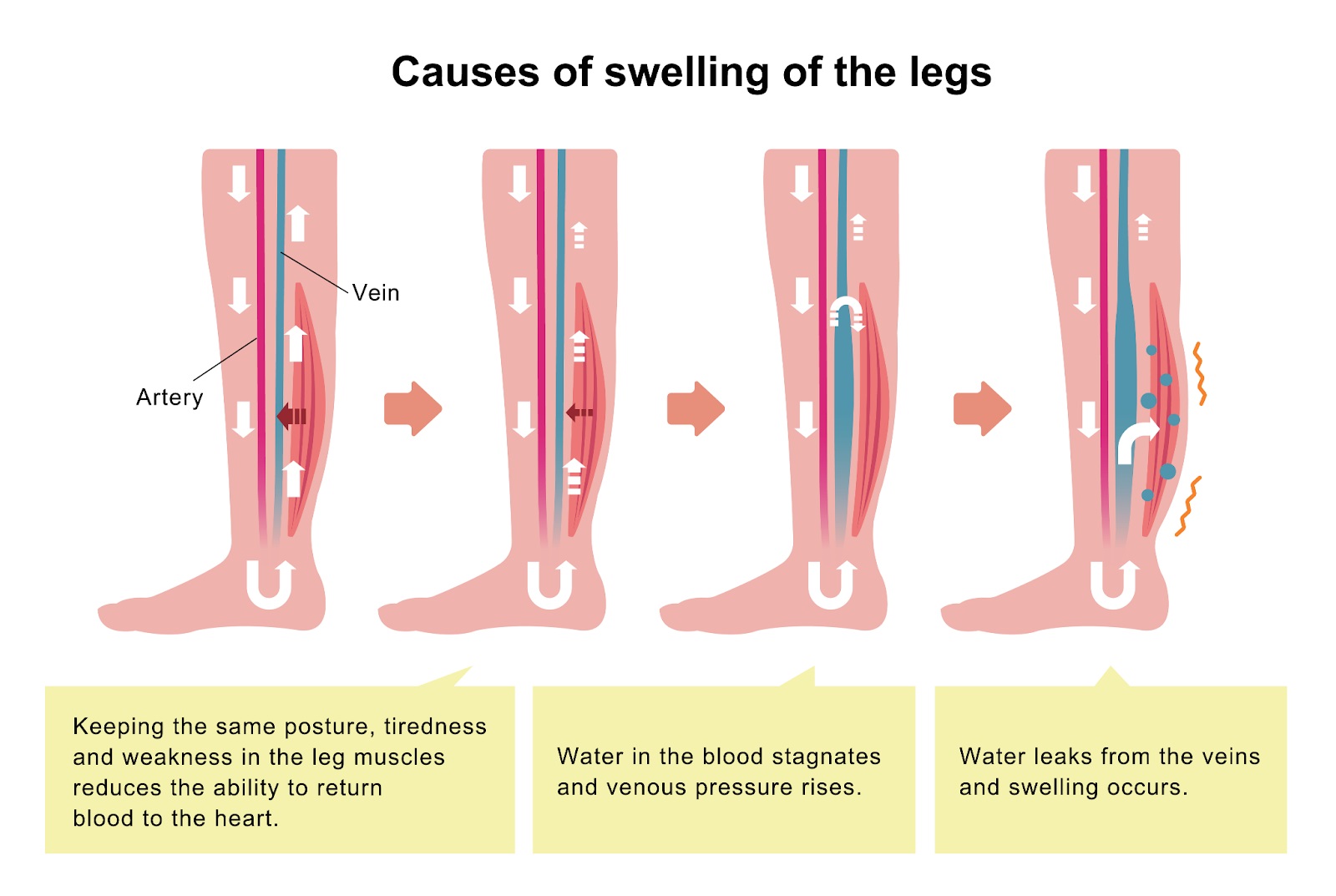 When Is Leg Swelling A Sign Of Something Serious Hamilton Vascular